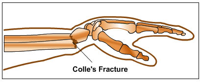 Colle's Fractures Treatment-Frederick MD