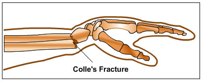 colles fracture