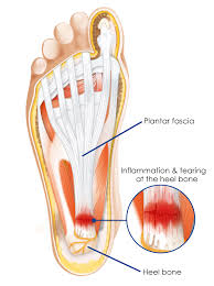 sole pain treatment